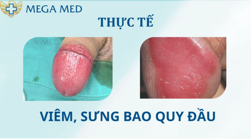 Hình ảnh bao quy đầu bị viêm 